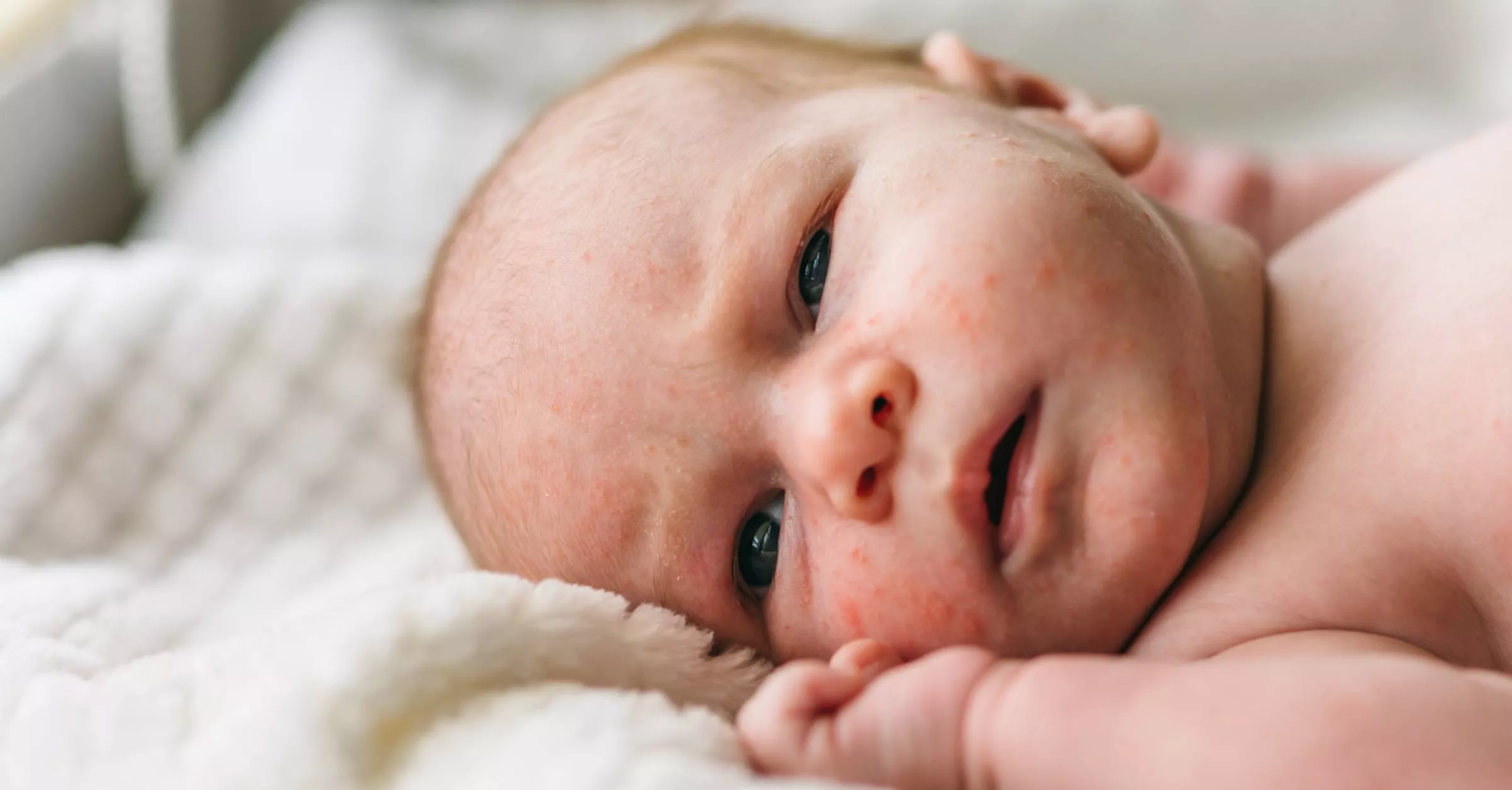 What is Baby Acne? Why Does It Happen?