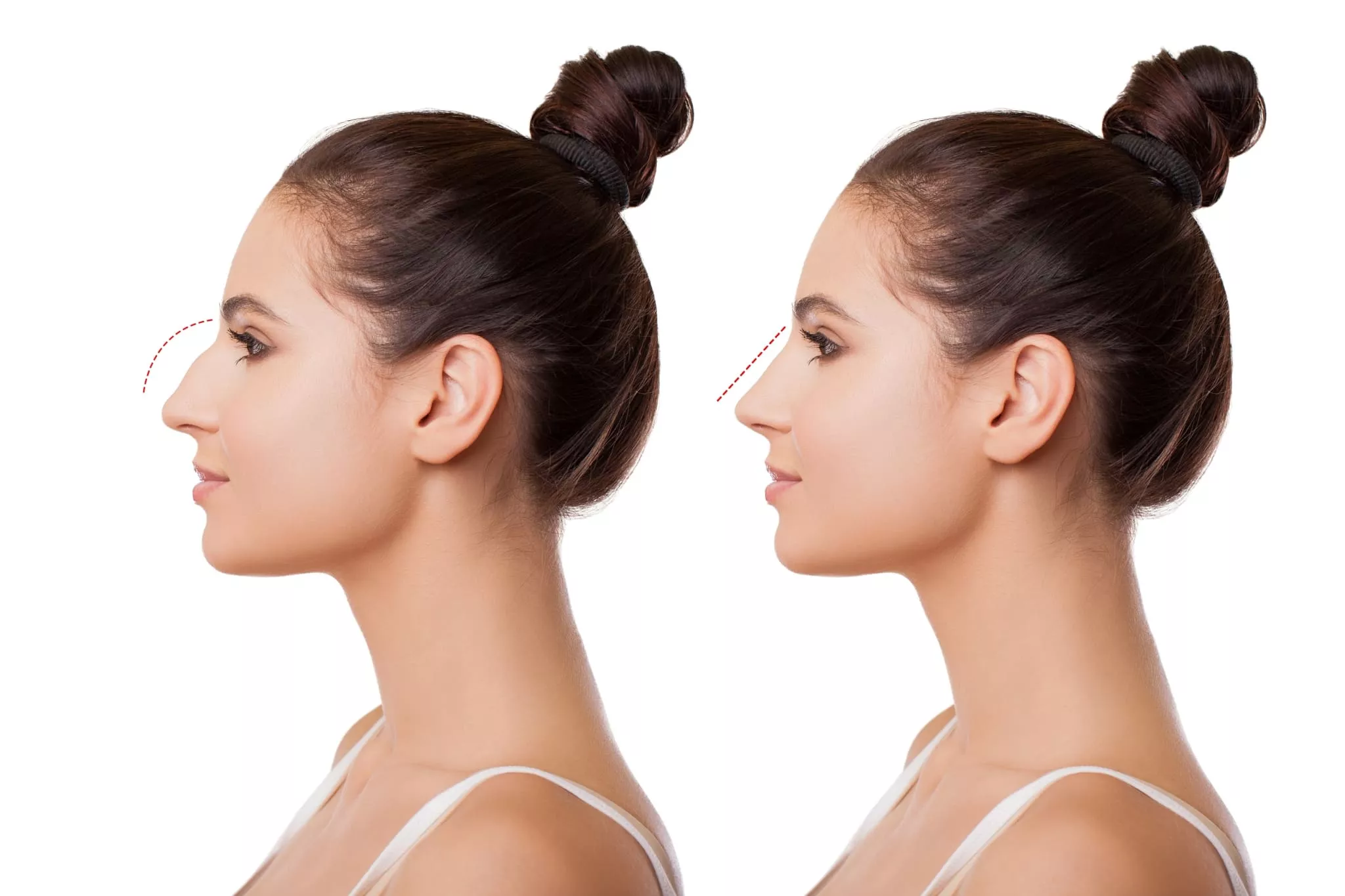 What Should Be Known About Rhinoplasty?