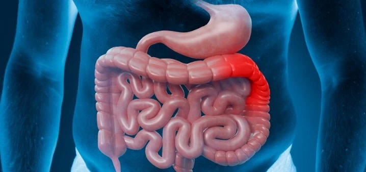 Crohn Hastalığı