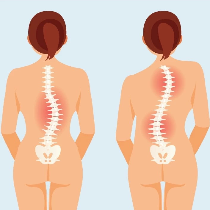 What is Scoliosis Corset and What Is It Used For?