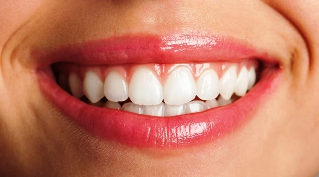 Diş Beyazlatma (Bleaching): Diş Hekiminin Gözünden Detaylı Bir Bakış