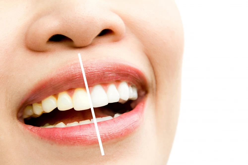 Tooth Whitening: An Important Step in Dental Aesthetics