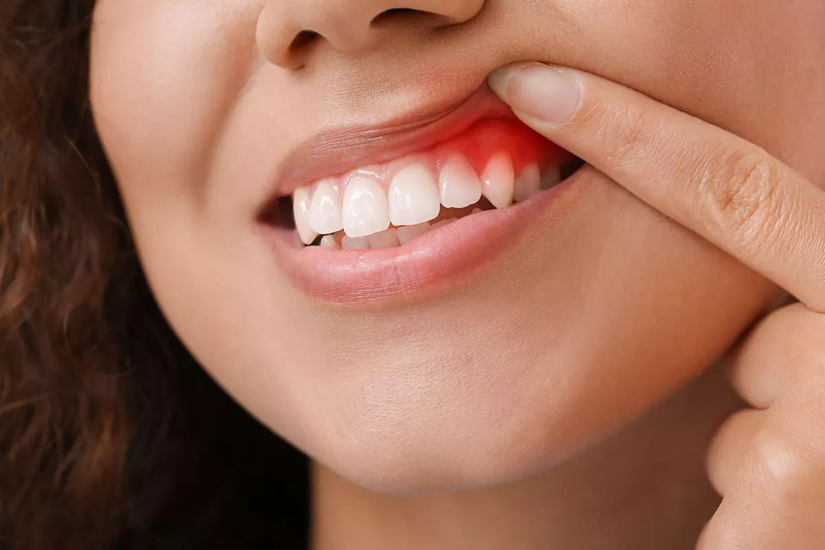 Treatment Methods Against Gum Diseases
