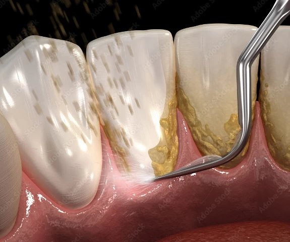 Importance of Dental Calculus Cleaning
