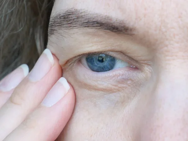 Eyelid Drooping Is More Than Just a Cosmetic Concern