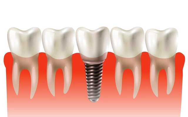 Dental Implantation in Dentistry