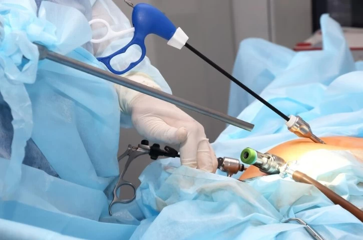 Laparoscopic Hysterectomy: Reasons, Process, and Treatment Methods