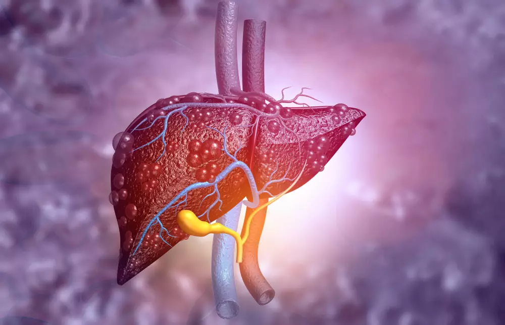 Karaciğer Yağlanması Nedir? Karaciğer Yağlanmasının Tedavi Şekli