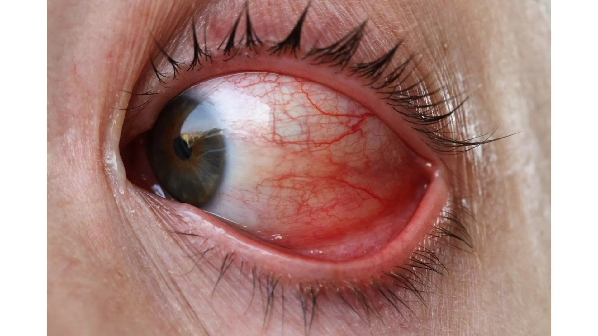 What is Conjunctivitis?