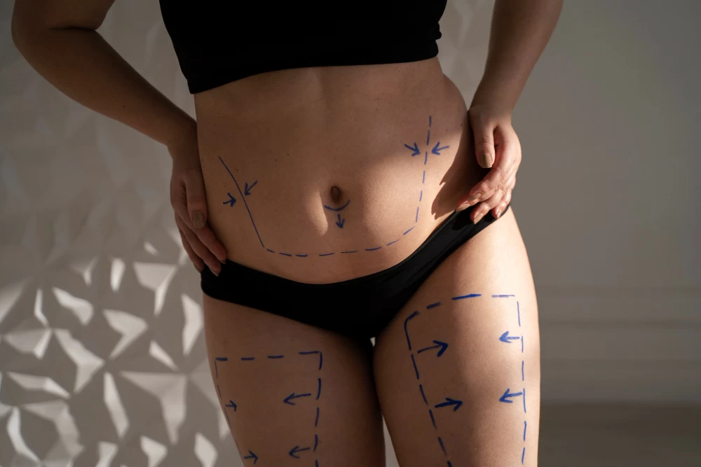 Liposuction ile Vücut Şekillendirme