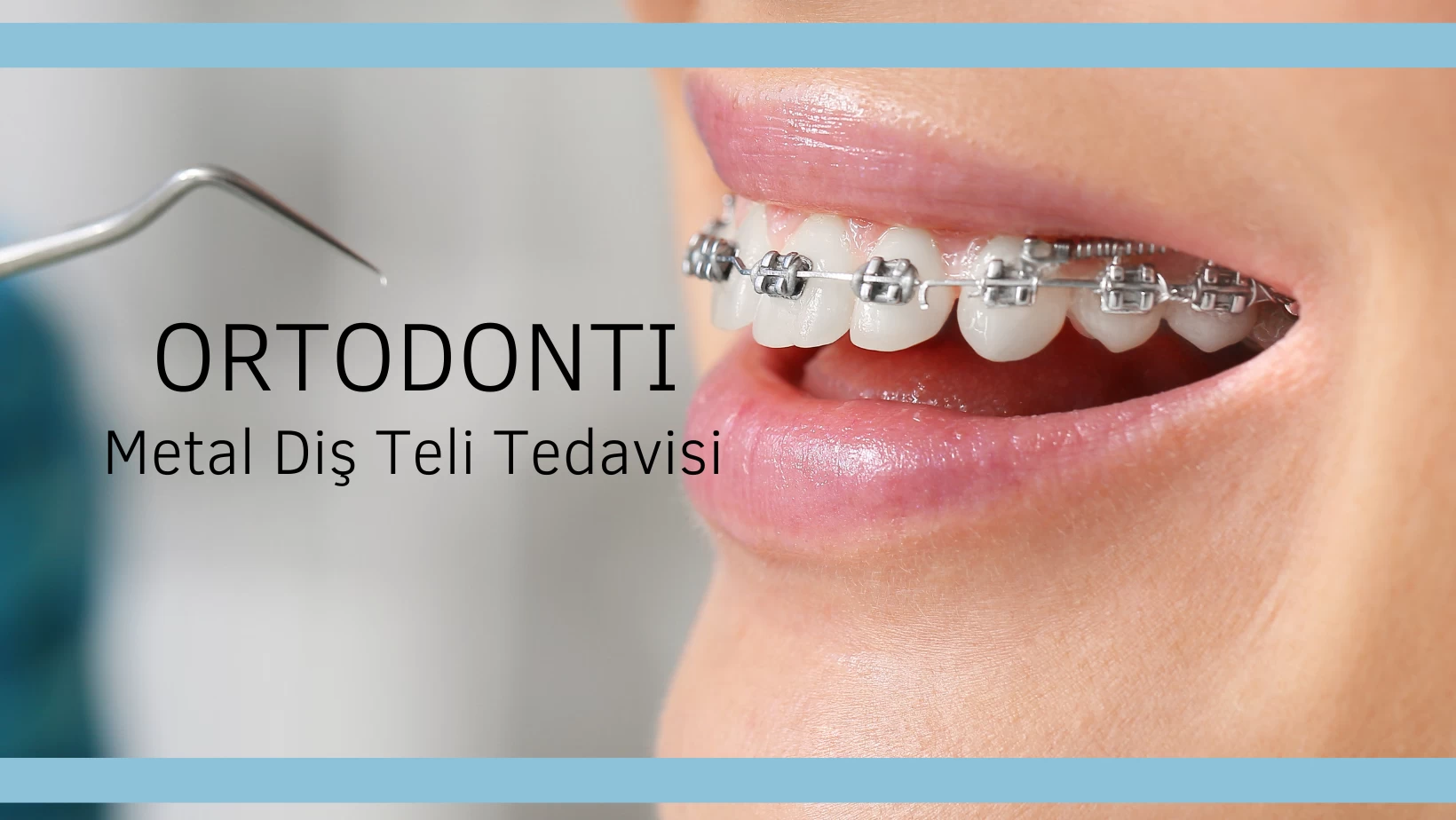 Metal Diş Teli Tedavisi Nasıl Yapılır?