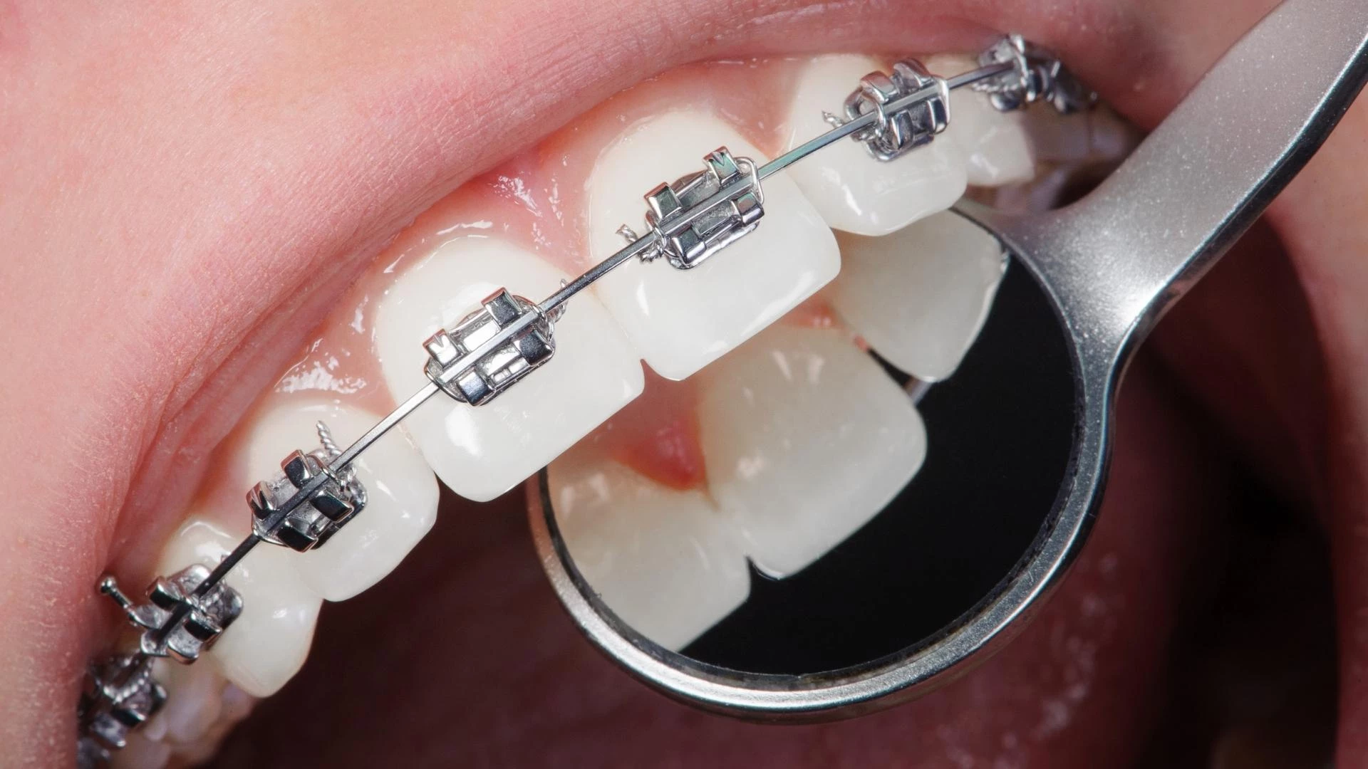 How much Orthodontic Treatment cost?