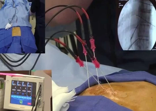 Radiofrequency Method for Pain Treatment