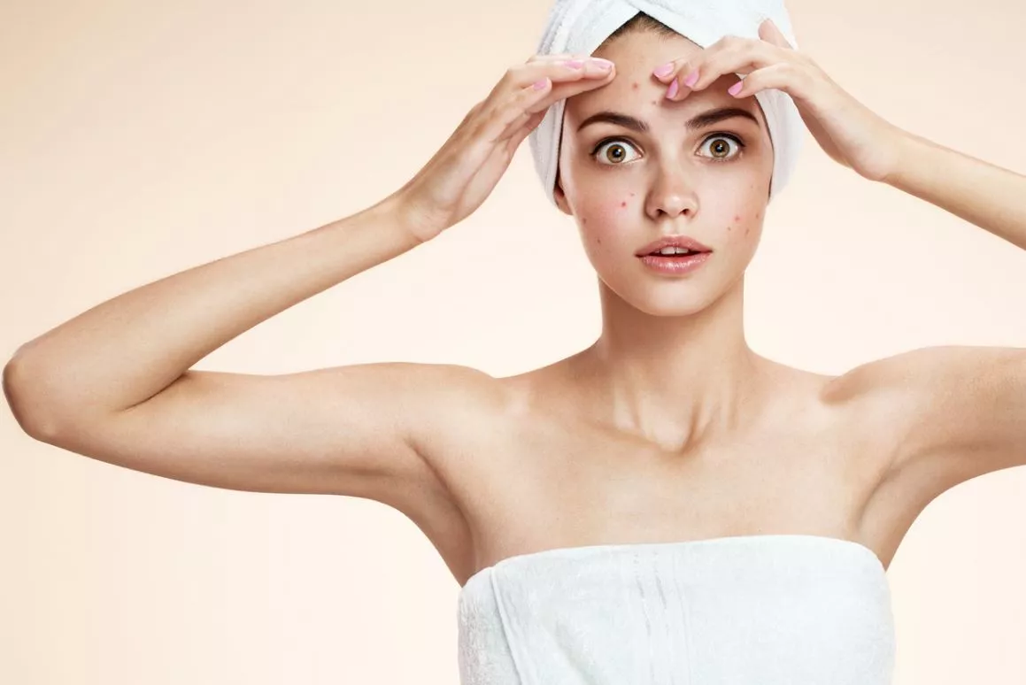 How Do You Get Rid of Acnes?