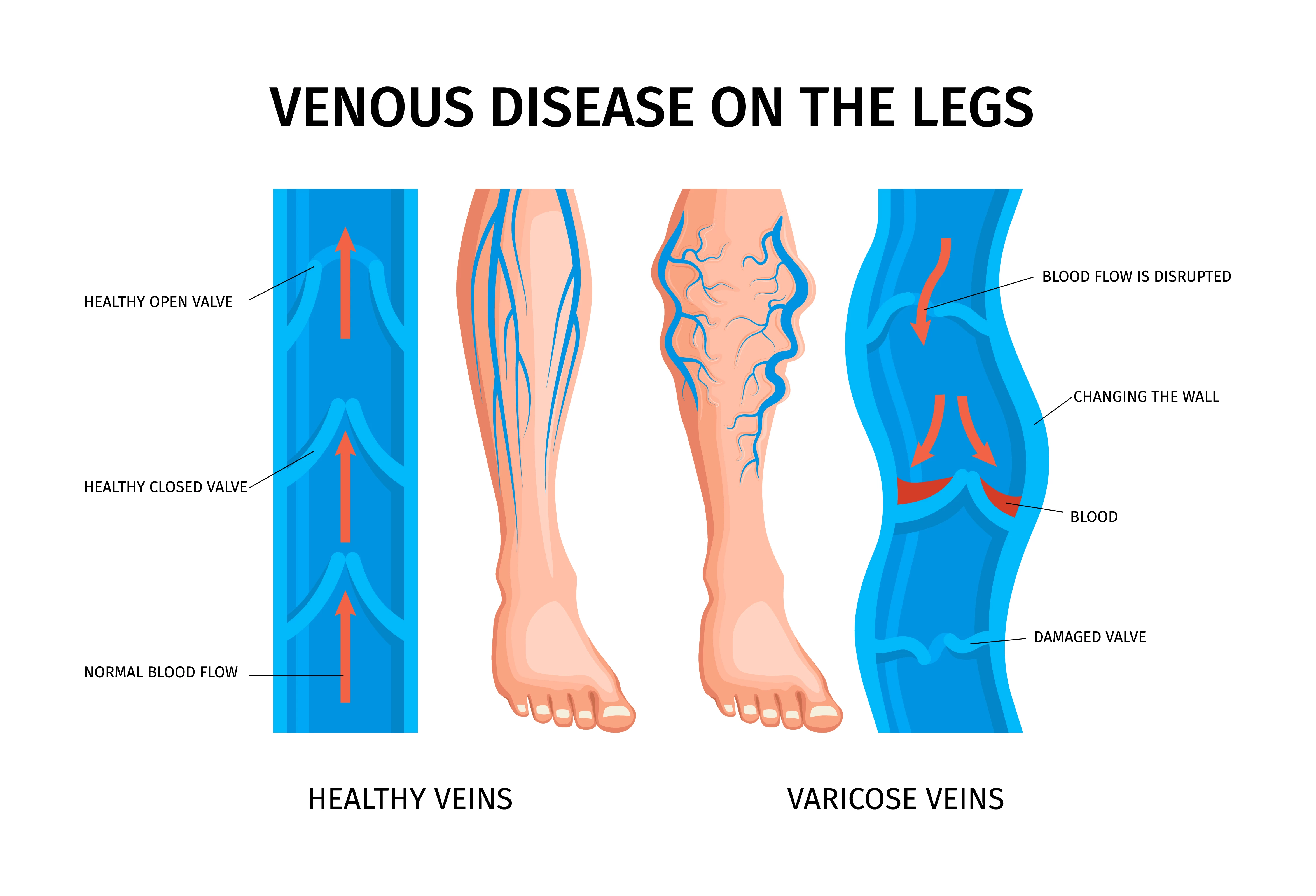 Recovery Processes After Varicose Veins Treatment