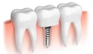 Dental İmplant Nedir?