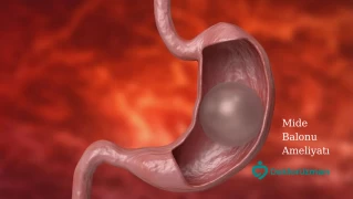 Mide Balonu Ameliyatı doktoruzman