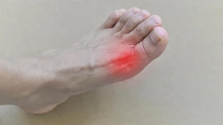 What is Gout?