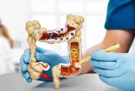 Kolorektal Kanser Riskini Azaltmanın Altı Yolu