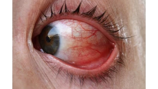 What is Conjunctivitis?