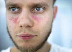 What is Lupus (Butterfly Disease)? Symptoms and Treatment Methods doktoruzman
