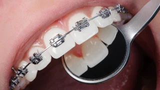 How much Orthodontic Treatment cost? doktoruzman