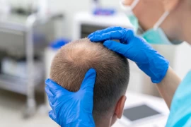 Permanent and Natural Hair with Fue Method