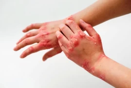 Psoriasis