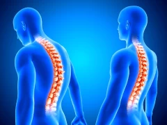 Skoliosis is Not a Disease